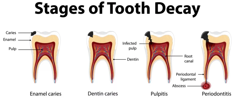 Progression of a Tooth Infection: Timeline and Stages